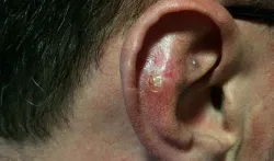 ear cancer- India TV Hindi