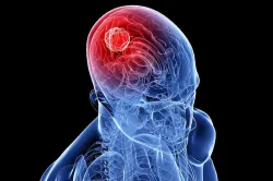 <p>brain cancer</p>- India TV Hindi