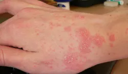 Scabies - India TV Hindi