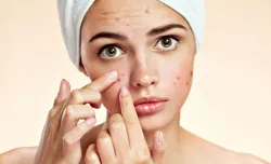 Pimple or acne - India TV Hindi