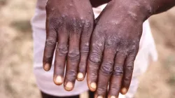 All you need to know about Monkeypox- India TV Hindi