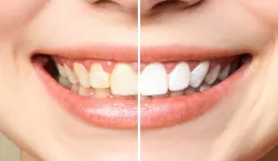 Teeth Whitening Tips- India TV Hindi