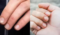 White Spots on Nails- India TV Hindi