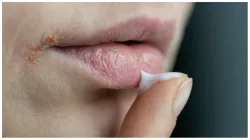 Vitamin_deficiency_chapped_lips- India TV Hindi