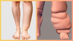 Filariasis causes in hindi- India TV Hindi