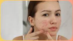 pimple free skin tips- India TV Hindi