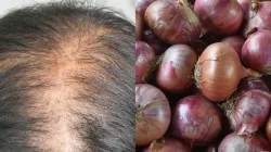 Onion hair mask for hair- India TV Hindi