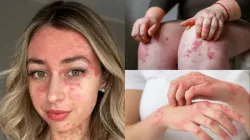 Skin psoriasis - India TV Hindi