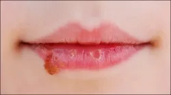 Dry Lips- India TV Hindi