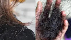 Home Remedy for Dandruff and Hair Fall - India TV Hindi