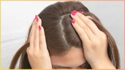 dandruff hair fall- India TV Hindi