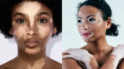 World Vitiligo Day - India TV Hindi