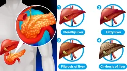 लिवर से जुड़ी बीमारी- India TV Hindi