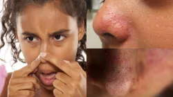 how to remove nose acne - India TV Hindi