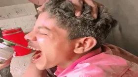 दांत निकले थे बाहर, ठीक करने के लिए दोस्त ने चला दी पत्थर काटने वाली मशीन, Video देख सदमे में चले गए डेंटिस्ट्स