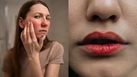 फटे होंठ से हैं परेशान तो करें इस विटामिन का इस्तेमाल, लिप्स के किनारों के साथ स्किन भी होगी सॉफ्ट 