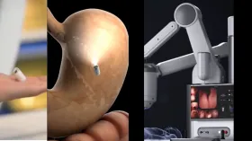 चीन ने किया दुनिया का बड़ा कमाल, AI-पावर्ड कैप्सूल खाने से हो जाएगी पेट की जांच; एंडोस्कोपी की पीड़ा से छुट्टी