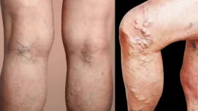 Varicose Veins कितनी खतरनाक? क्यों होती है ये बीमारी? पैरों में दिखने लगती हैं उभरी हुई नीली नसें
