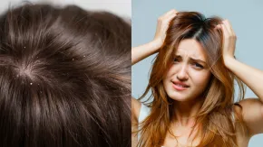 डॉक्टर ने बताया किन वजहों से तेजी से झड़ते हैं बाल और क्या हैं बचाव के उपाय?