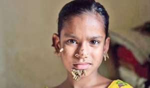 bangladesh treats first case of tree girl syndrome - India TV ...