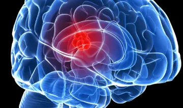 blocking a key protein may stop deadly brain tumour...- India TV Hindi