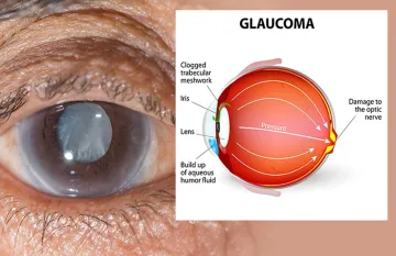 glaucoma - India TV Hindi