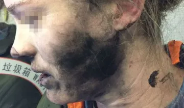 headphone battery torn in air burn woman face- India TV Hindi