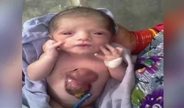 baby born with heart beating outside her chest- India TV Hindi