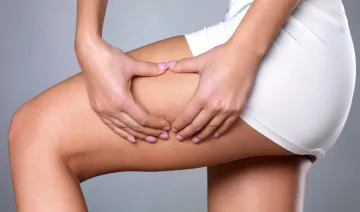 cellulite- India TV Hindi