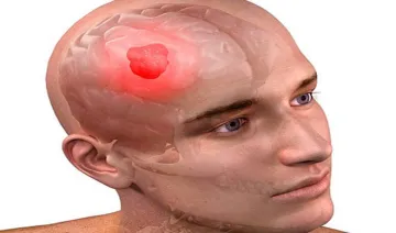 brain tumor- India TV Hindi