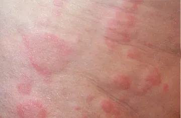 skin allergic- India TV Hindi