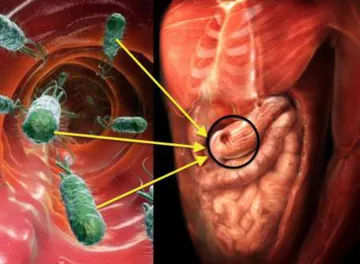 Gut bacteria control cancer immunity in the liver- India TV Hindi