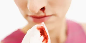 <p>Nose bleeding</p>- India TV Hindi