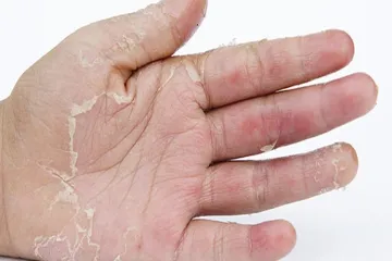<p>skin peeling</p>- India TV Hindi
