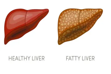 <p>Fatty liver</p>- India TV Hindi