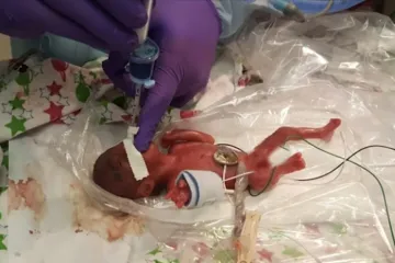 Meet Saybie, the world’s smallest known surviving baby | Photo: Sharp Hospital- India TV Hindi