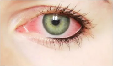 Eye Infection- India TV Hindi