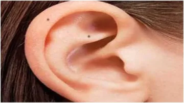 ear moles - India TV Hindi