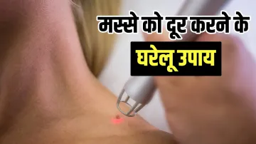 <p>Home remedy to remove warts</p>- India TV Hindi