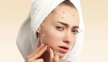 homemade face pack for acne marks know how to Get rid acne at home with potato rice water and lemon - India TV Hindi