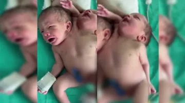 A woman gave birth to a baby having two heads and three hands in Ratlam Madhya Pradesh.- India TV Hindi