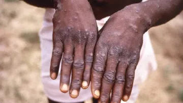 Monkeypox Cases In India- India TV Hindi