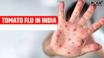 More than 100 cases of tomato flu- India TV Hindi