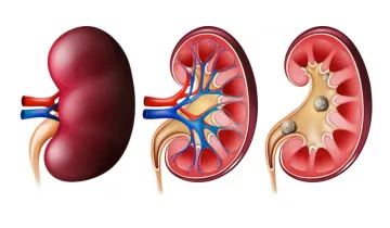 Kidney Stone- India TV Hindi