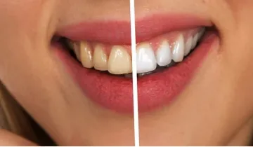 दांतों के पीलेपन से हैं परेशान? - India TV Hindi