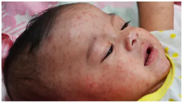measles- India TV Hindi