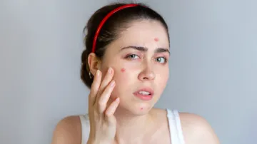  how_to_get_rid_of_pimples_overnight - India TV Hindi