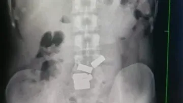 X-ray की तस्वीर।- India TV Hindi