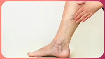 Varicose_veins- India TV Hindi