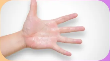  excessive sweating of the hands - India TV Hindi